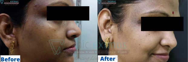 Pigmentation Treatment