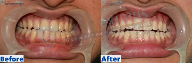 Before After Teeth Whitening 1