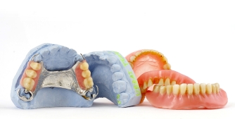Cast Partial Denture - Stable and retentive with a metal and acrylic framework.