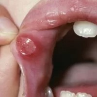 Deficiency Ulcers