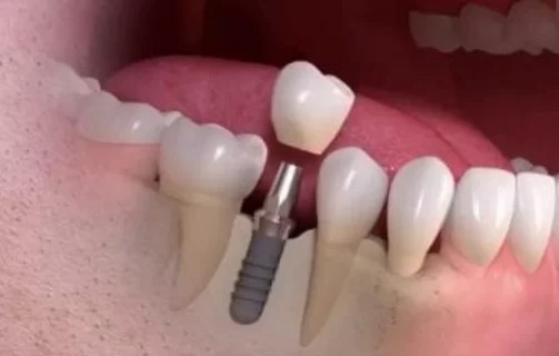 Dental Implant general dentistry