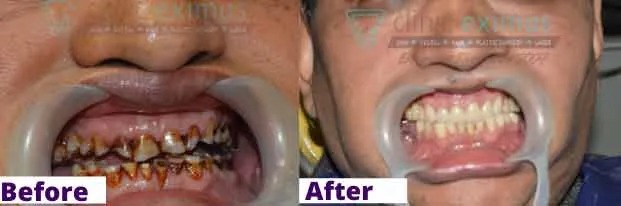 Full Mouth Rehabilitation FMR before and after