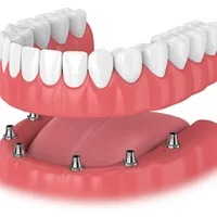 Implant-Supported Denture - Fixed denture with superior chewing power