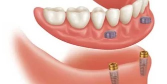 Implant-Based Denture - Dental implants for fixed and powerful denture