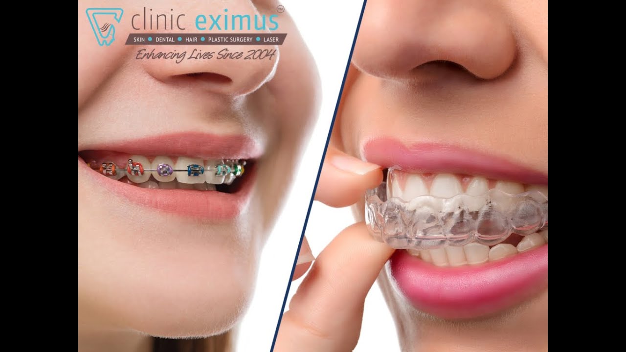 Invisalign - INVISIBLE BRACES