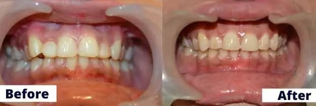 Invisible Braces before and after