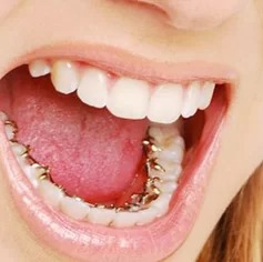 Lingual dental