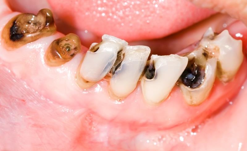 Preventive Dentistry side