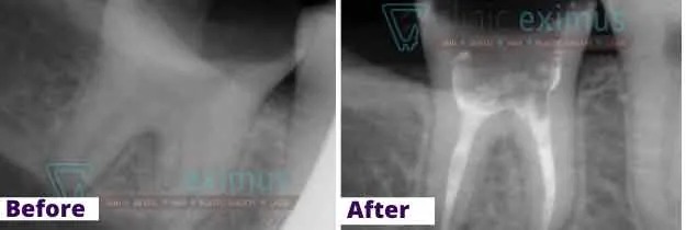 Root Canal Treatment Before And After