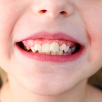 Save milk teeth as far as possible