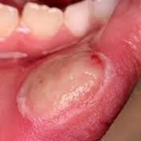 Secondary Ulcers