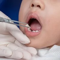 Teeth removal in kids