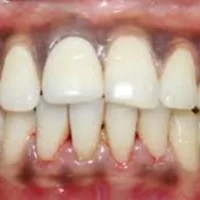 Tooth Colored Dental Fillings 2