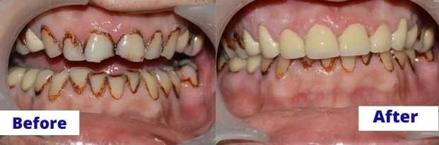 Veneers and Laminates before and after