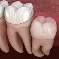 Wisdom Tooth dental